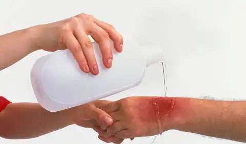 مبادئ إسعاف «الحروق»